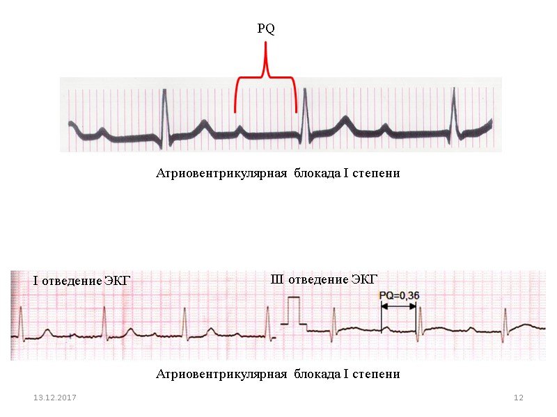 Атриовентрикулярная  блокада I степени 13.12.2017 12 Атриовентрикулярная  блокада I степени PQ III